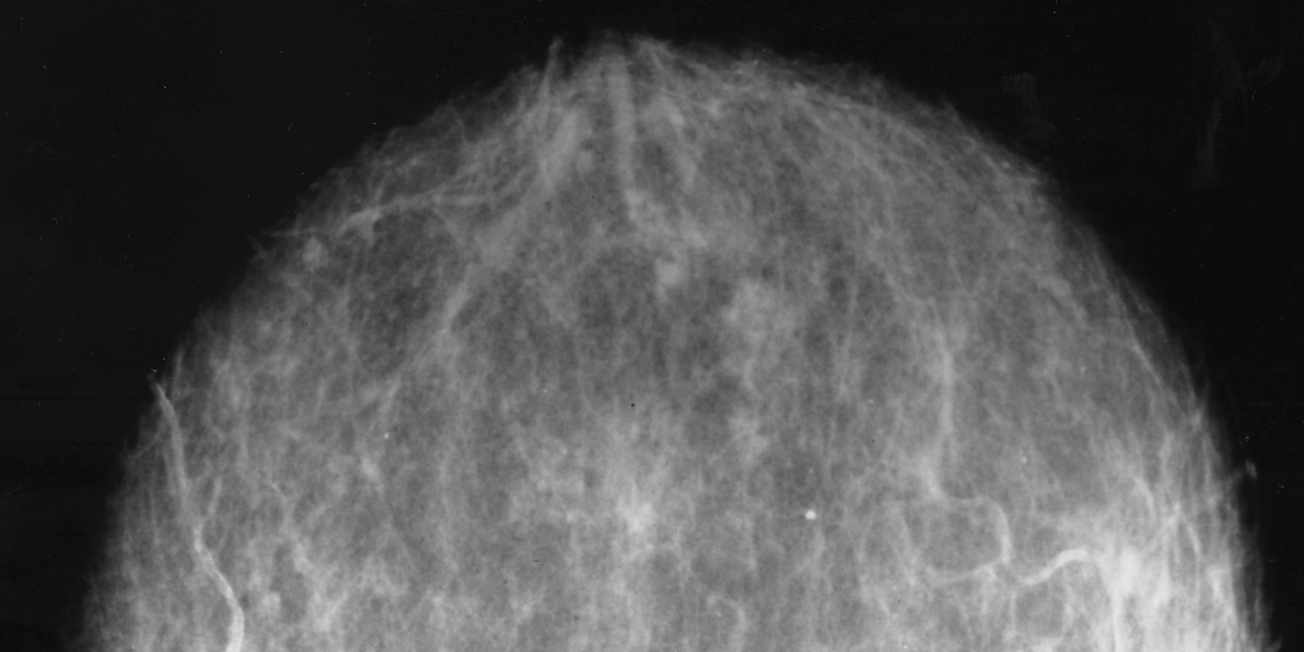About Abnormal Mammograms