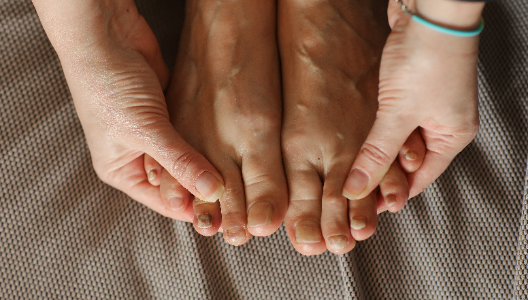 Can Affect Skin and Nails