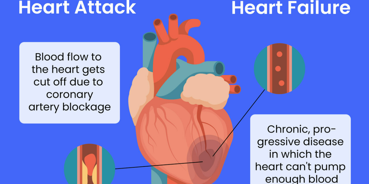 Difference Between a Heart Attack and Heart Failure