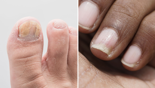Fungal Nail Infection