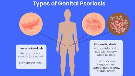 GettyImages-1394654771-1126111640-genital-psoriasis-types2.jpg