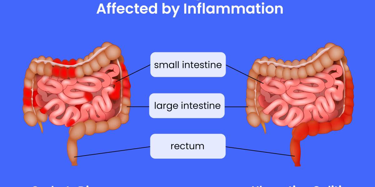 GettyImages-2110165626-crohns-uc-inflammation.jpg