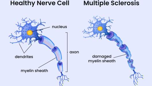 GettyImages-996997798-multiple-sclerosis-myelin-sheath.jpg