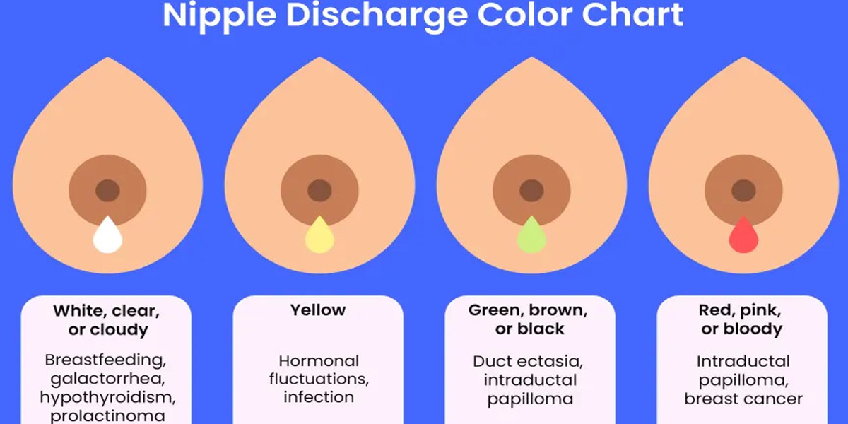 Is That Nipple Discharge Normal, or Cause for Concern?
