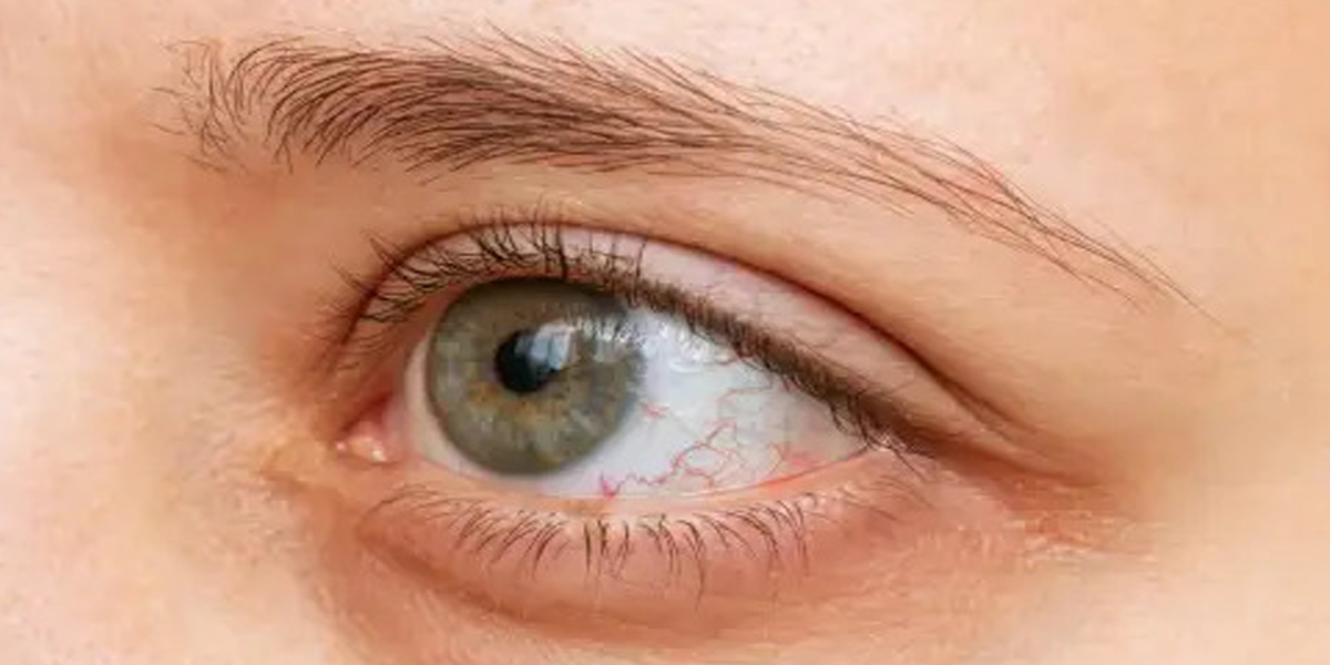 What to Know About Crohn’s and Your Vision