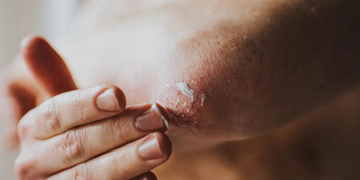 The Pros and Cons of Steroid Creams for Psoriasis