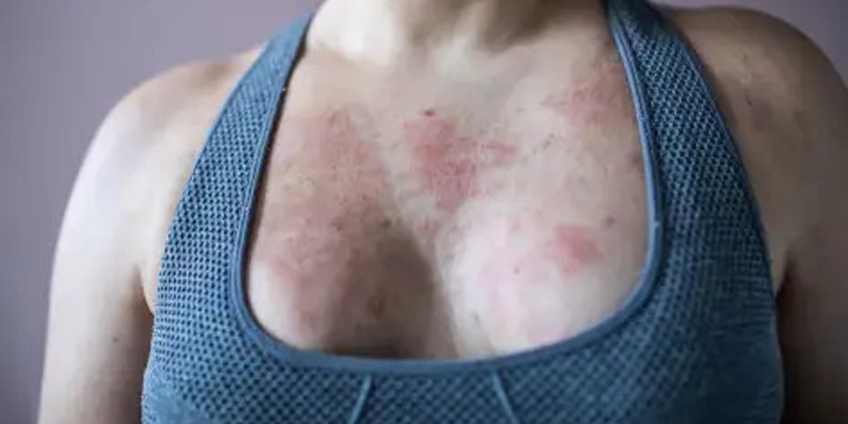 Eczema Can Show Up Anywhere, Even Your Breasts
