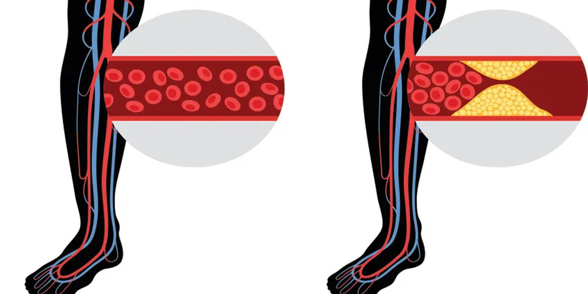 What to Know About Peripheral Artery Disease