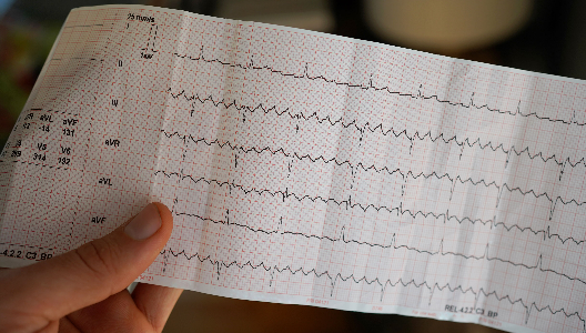 The Key Differences Between AFib and Atrial Flutter