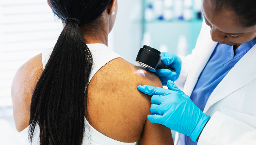 Type of Skin Cancer
