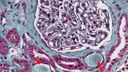 Understanding Cholesterol Embolism