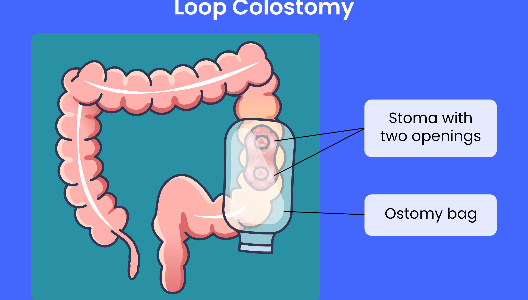 Understanding the Loop Colostomy Procedure