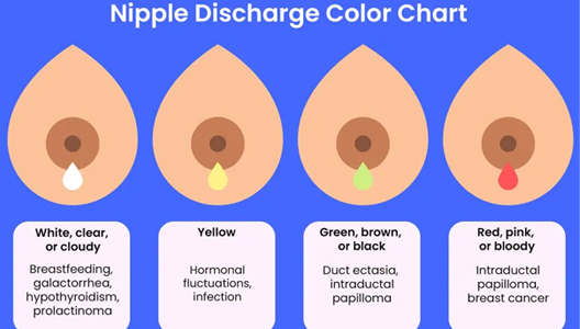 Does Nipple Discharge Ever Signify Breast Cancer?