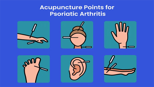 Exploring the Benefits of Acupuncture for Psoriatic Arthritis