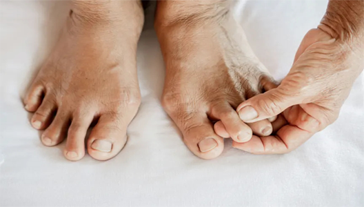 Up to 70% of PsA Warriors Have Toe Involvement
