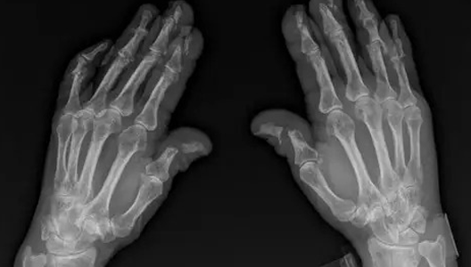 What Is Pencil-in-Cup Deformity With Psoriatic Arthritis 