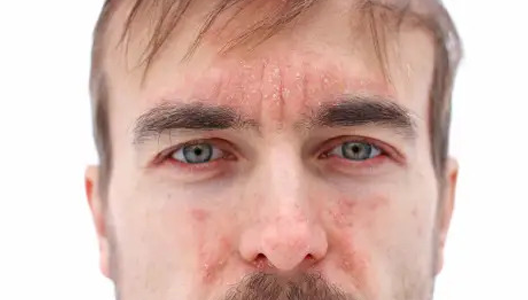 Defining Nasal Psoriasis 