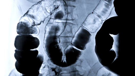 Tests and Diagnostics for Crohn’s 