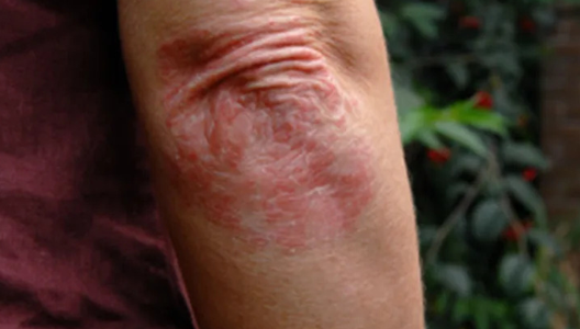 Taking Care of Your Advanced Psoriasis