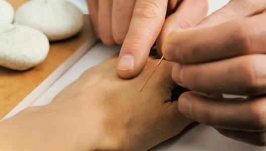 Could Acupuncture Help Your Skin Symptoms?
