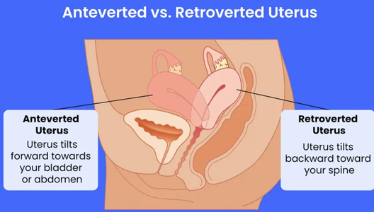 The Majority of Women Have This Type of Uterus