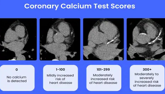 Should You Have a Coronary Calcium Test? 