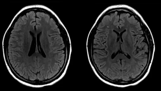 What an MRI Reveals About the ‘Migraine Brain’