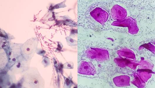 candida-vs-bacterial-vaginosis-GettyImages-1492938179-583855154-3000x2000.jpg