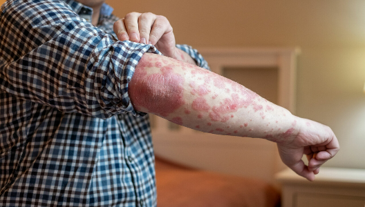 Why Your Skin May Hurt if You Have Psoriasis