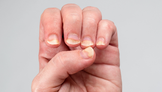 What to Know About PsA and Nail Damage