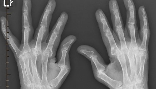 What You Should Know About RA in the Hands