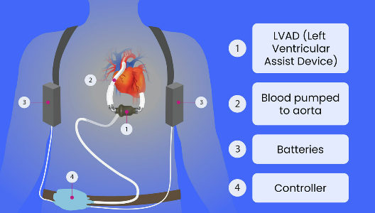 How an LVAD Pump Works for Heart Failure