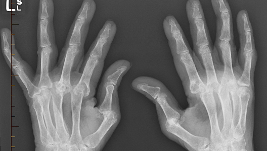 What Is Proctosigmoiditis