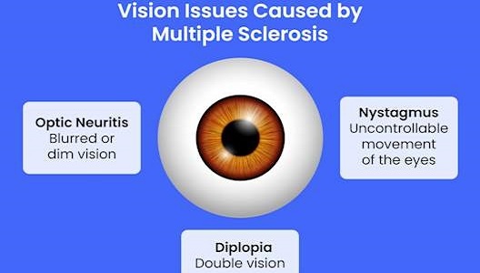 large-GettyImages-1401819462-ms-vision-issues.jpg