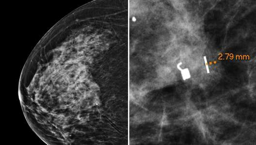 large-breast-marker-3000x2000.jpg