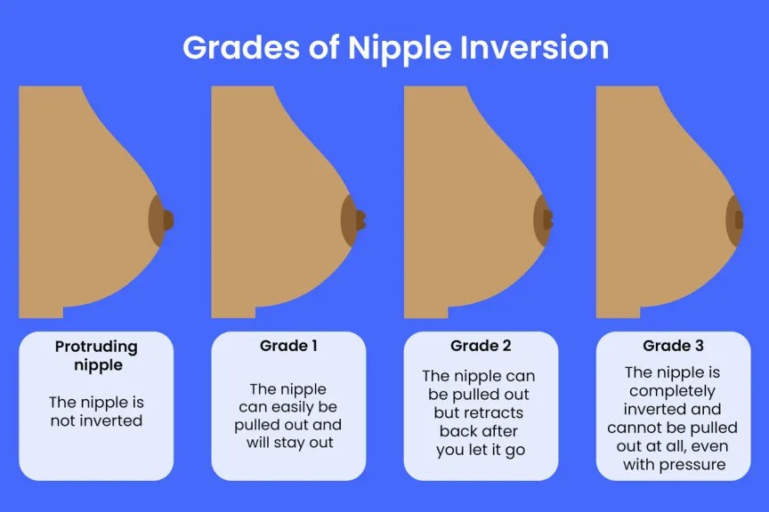 Inverted Nipples Are Nothing to Be Ashamed of