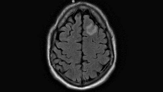 large-tumefactive-multiple-sclerosis-1-3000x2000.jpg