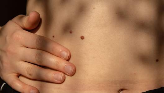 moles-on-skin-GettyImages-1406698148-3000x2000.jpg