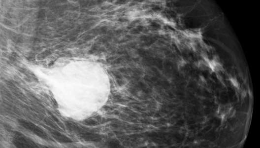 papillary-breast-cancer-mammogram-13c8a3a7b514db2632f38e75886210-3000x20000-sm.jpg