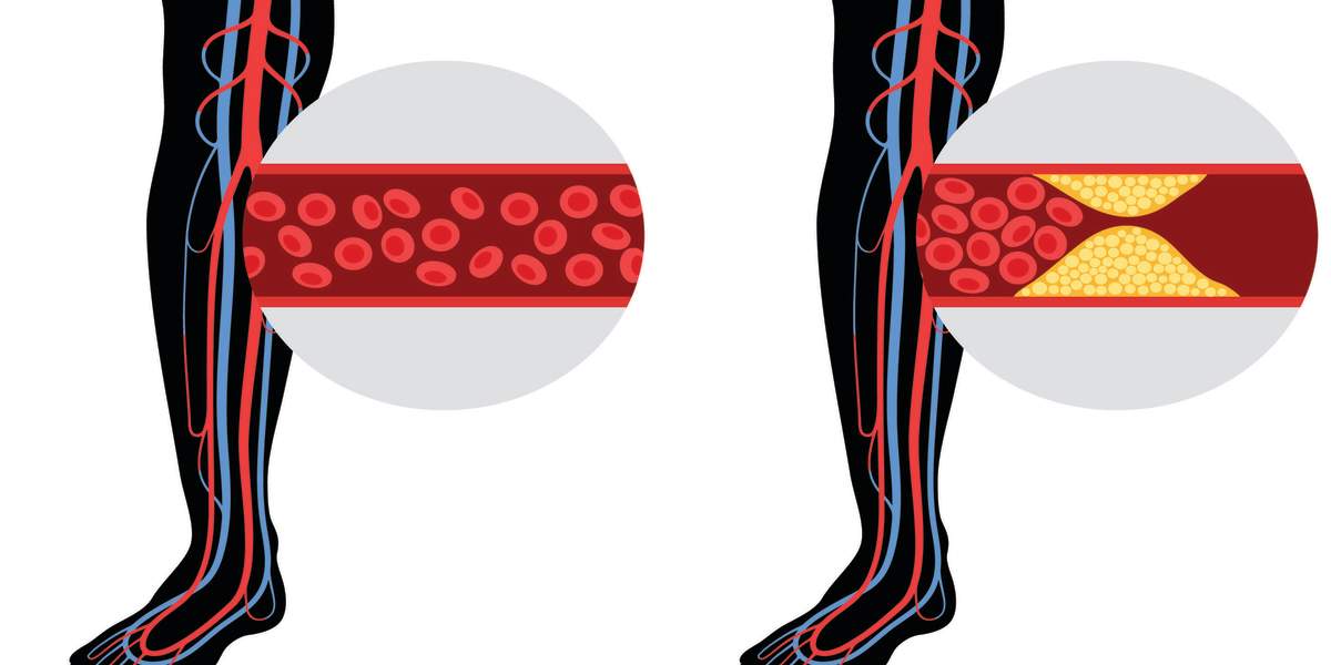 peripheral-artery-disease-pad-GettyImages-1336192163-3000x2000.jpg