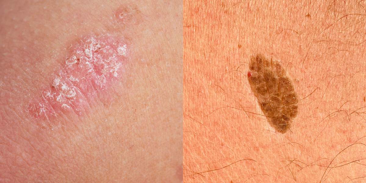 psoriasis-or-skin-cancer-GettyImages-136810224-1325934260-3000x2000.jpg