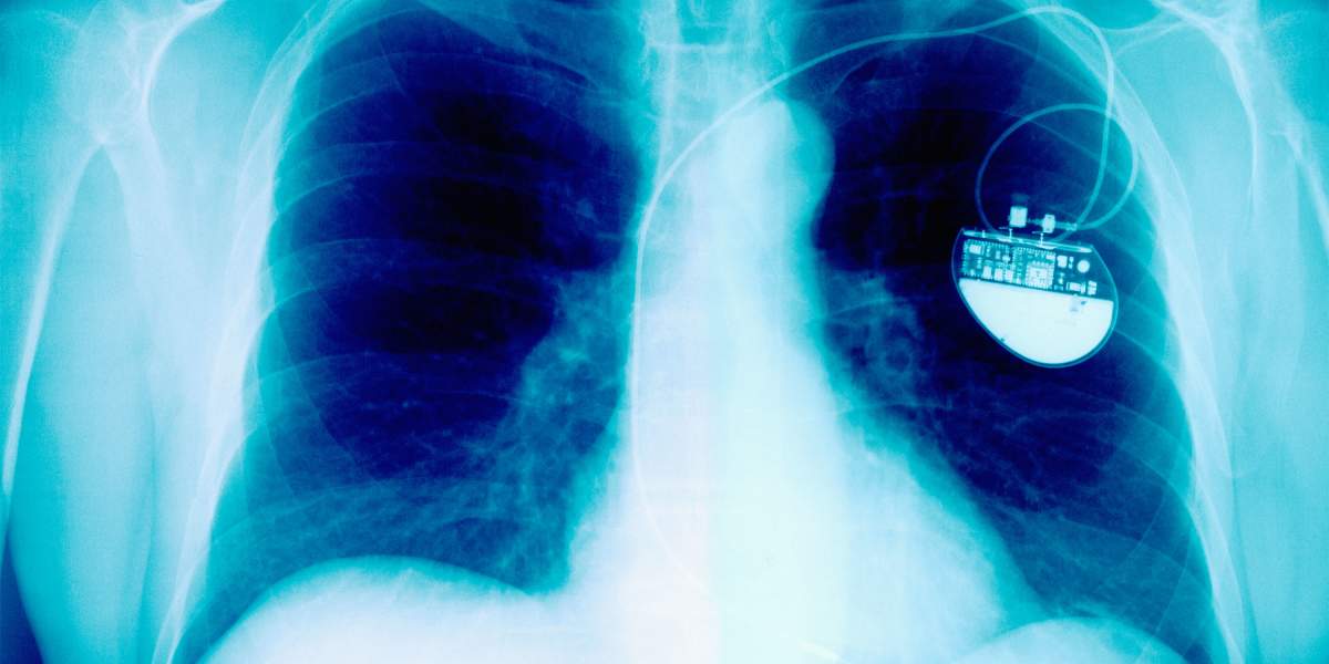 x-ray-showing-pacemaker-GettyImages-523306516-3000x2000.jpg