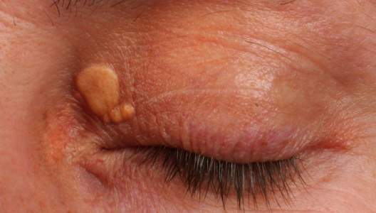 xanthelasma-on-the-eyelid-01-gettyimages-179801023.jpg
